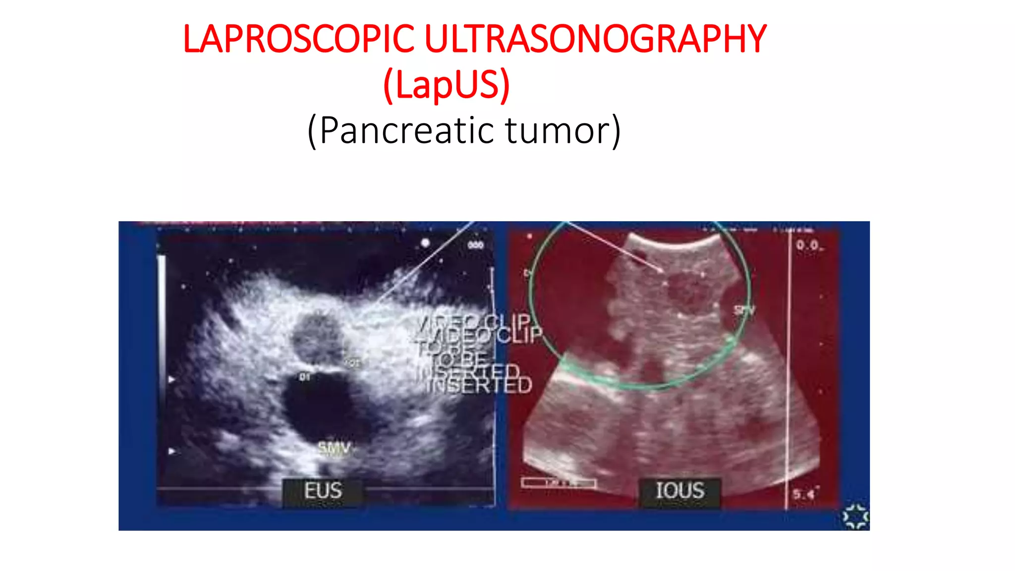 LAPROSCOPIC ULTRASONOGRAPHY
(LapUS)
(Pancreatic tumor)
 