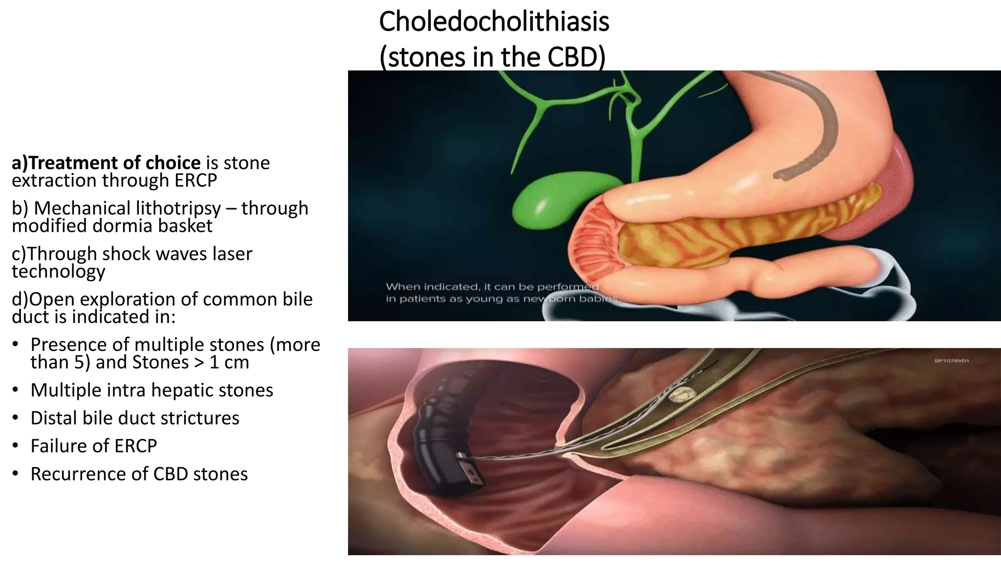 Choledocholithiasis
(stones in the CBD)
a)Treatment of choice is stone
extraction through ERCP
b) Mechanical lithotripsy – through
modified dormia basket
c)Through shock waves laser
technology
d)Open exploration of common bile
duct is indicated in:
• Presence of multiple stones (more
than 5) and Stones > 1 cm
• Multiple intra hepatic stones
• Distal bile duct strictures
• Failure of ERCP
• Recurrence of CBD stones
 