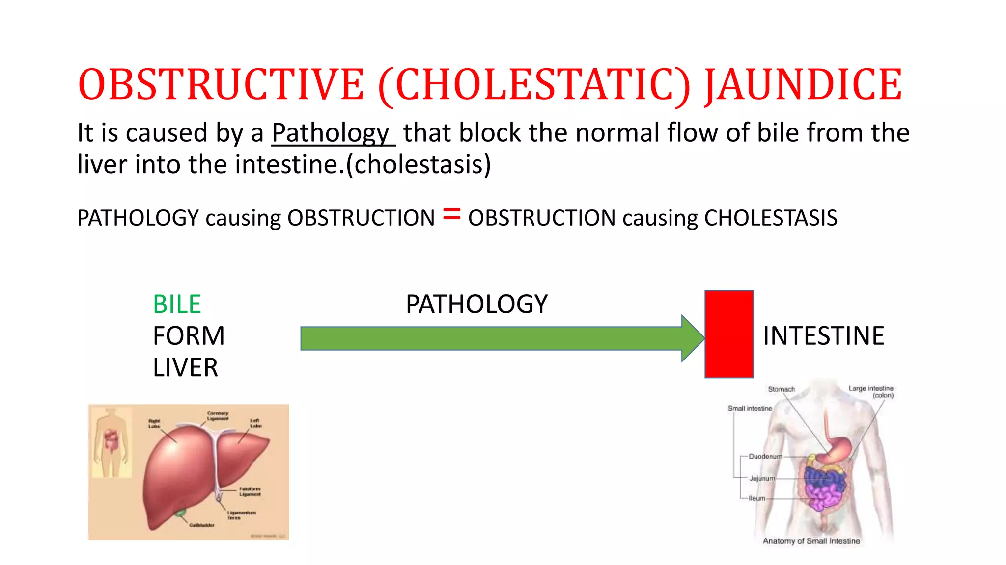 OBSTRUCTIVE (CHOLESTATIC) JAUNDICE
It is caused by a Pathology that block the normal flow of bile from the
liver into the intestine.(cholestasis)
PATHOLOGY causing OBSTRUCTION =OBSTRUCTION causing CHOLESTASIS
BILE PATHOLOGY
FORM INTESTINE
LIVER
 