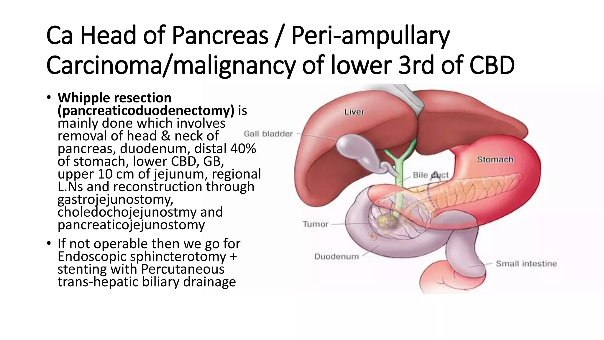 Ca Head of Pancreas / Peri-ampullary
Carcinoma/malignancy of lower 3rd of CBD
• Whipple resection
(pancreaticoduodenectomy) is
mainly done which involves
removal of head & neck of
pancreas, duodenum, distal 40%
of stomach, lower CBD, GB,
upper 10 cm of jejunum, regional
L.Ns and reconstruction through
gastrojejunostomy,
choledochojejunostmy and
pancreaticojejunostomy
• If not operable then we go for
Endoscopic sphincterotomy +
stenting with Percutaneous
trans-hepatic biliary drainage
 