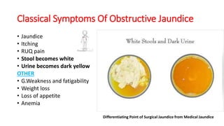 Classical Symptoms Of Obstructive Jaundice
• Jaundice
• Itching
• RUQ pain
• Stool becomes white
• Urine becomes dark yellow
OTHER
• G.Weakness and fatigability
• Weight loss
• Loss of appetite
• Anemia
Differentiating Point of Surgical Jaundice from Medical Jaundice
 