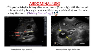 ABDOMINAL USG
• The portal triad in biliary ultrasound scans (Normally), with the portal
vein comprising Mickey's head and the common bile duct and hepatic
artery the ears. . (”Mickey Mouse" sign)
Mickey Mouse" sign (Normal) Mickey Mouse" sign Obliterated
 