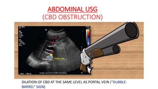 ABDOMINAL USG
(CBD OBSTRUCTION)
DILATION OF CBD AT THE SAME LEVEL AS PORTAL VEIN (“DUBBLE-
BARREL” SIGN)
 