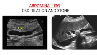 ABDOMINAL USG
CBD DILATION AND STONE
 