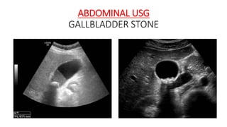 ABDOMINAL USG
GALLBLADDER STONE
 