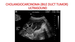 CHOLANGIOCARCINOMA (BILE DUCT TUMOR)
ULTRASOUND
 