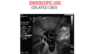 ENDOSCOPIC USG
(DILATED CBD)
 