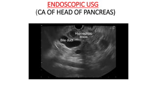 ENDOSCOPIC USG
(CA OF HEAD OF PANCREAS)
 