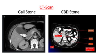 CT-Scan
Gall Stone CBD Stone
 