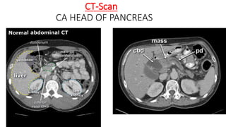 CT-Scan
CA HEAD OF PANCREAS
 