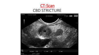 CT-Scan
CBD STRICTURE
 