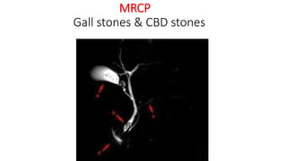 MRCP
Gall stones & CBD stones
 