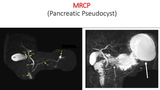 MRCP
(Pancreatic Pseudocyst)
 