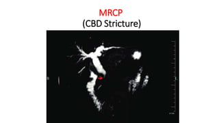 MRCP
(CBD Stricture)
 