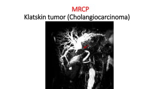 MRCP
Klatskin tumor (Cholangiocarcinoma)
 