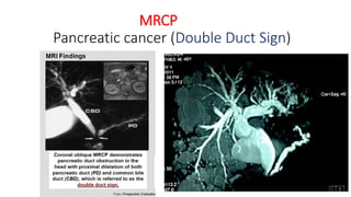 MRCP
Pancreatic cancer (Double Duct Sign)
 