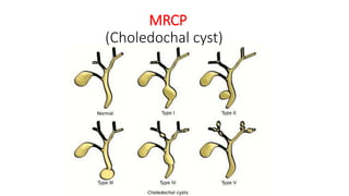 MRCP
(Choledochal cyst)
 