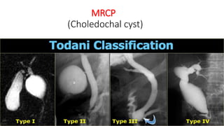 MRCP
(Choledochal cyst)
 