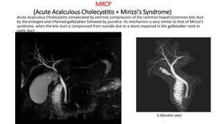 MRCP
(Acute Acalculous Cholecystitis + Mirizzi’s Syndrome)
Acute Acalculous Cholecystitis complicated by extrinsic compression of the common hepatic/common bile duct
by the enlarged and inflamed gallbladder followed by jaundice. Its mechanism is very similar to that of Mirizzi’s
syndrome, when the bile duct is compressed from outside due to a stone impacted in the gallbladder neck or
cystic duct
5-Months later
 