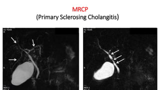 MRCP
(Primary Sclerosing Cholangitis)
 