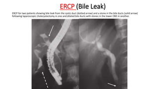 ERCP (Bile Leak)
ERCP for two patients showing bile leak from the cystic duct (dotted arrow) and a stone in the bile ducts (solid arrow)
following laparoscopic cholecystectomy in one and dilated bile ducts with stones in the lower CBD in another.
 
