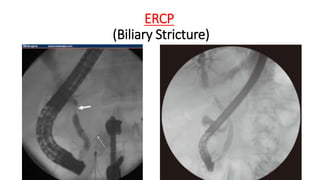 ERCP
(Biliary Stricture)
 
