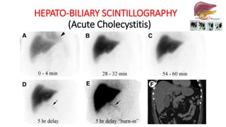 HEPATO-BILIARY SCINTILLOGRAPHY
(Acute Cholecystitis)
 