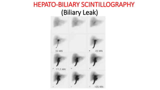 HEPATO-BILIARY SCINTILLOGRAPHY
(Biliary Leak)
 