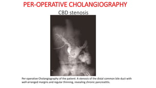 PER-OPERATIVE CHOLANGIOGRAPHY
CBD stenosis
Per-operative Cholangiography of the patient: A stenosis of the distal common bile duct with
well-arranged margins and regular thinning, revealing chronic pancreatitis.
 