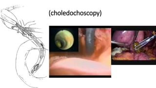 (choledochoscopy)
 