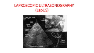 LAPROSCOPIC ULTRASONOGRAPHY
(LapUS)
 