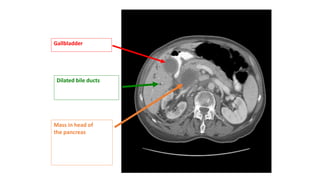 Gallbladder
Dilated bile ducts
Mass in head of
the pancreas
 