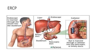 ERCP
 