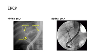 ERCP
Normal ERCP Normal ERCP
 