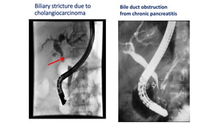 Biliary stricture due to
cholangiocarcinoma
Bile duct obstruction
from chronic pancreatitis
 