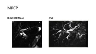 MRCP
Distal CBD Stone PSC
 