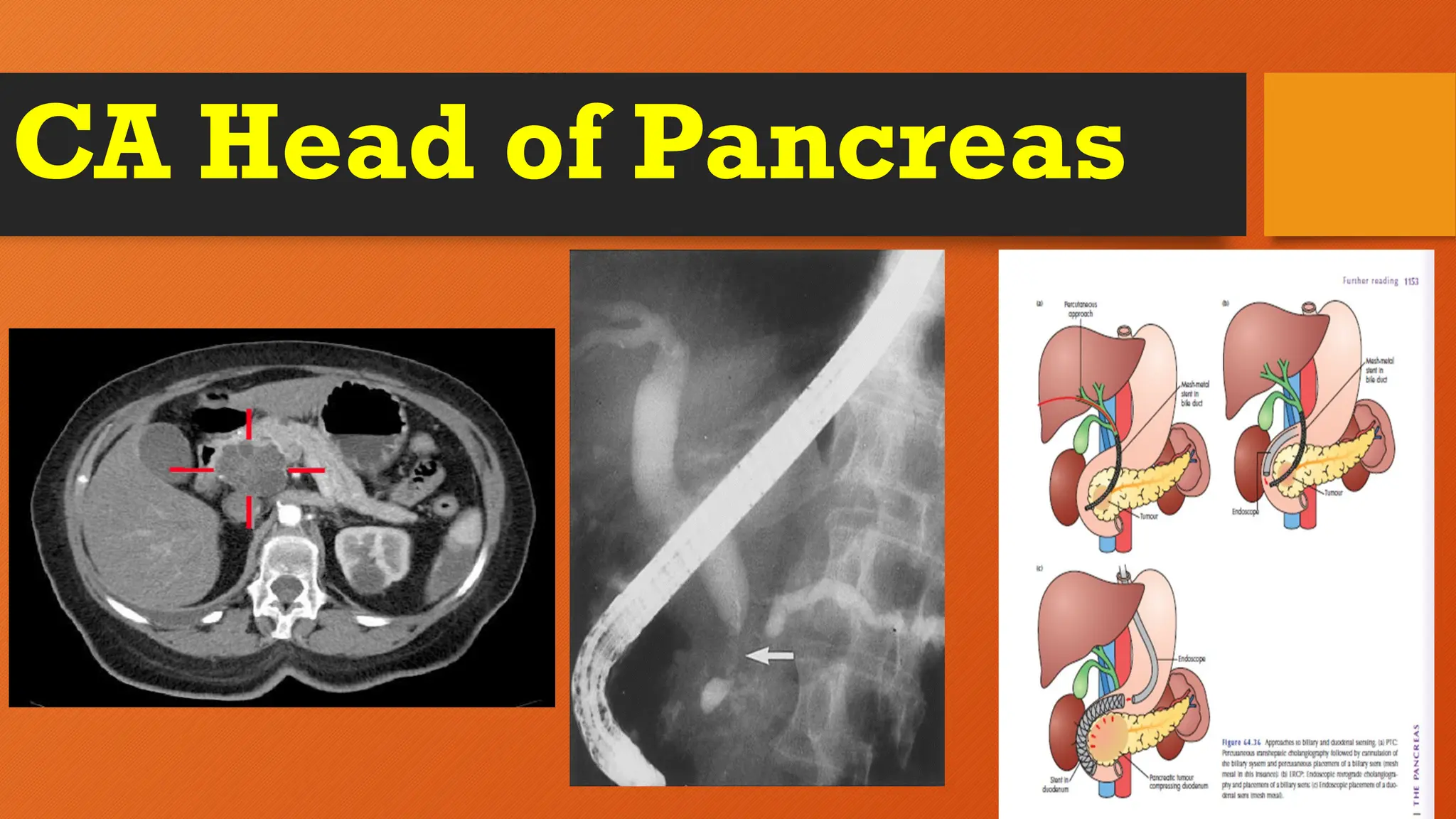 CA Head of Pancreas
 