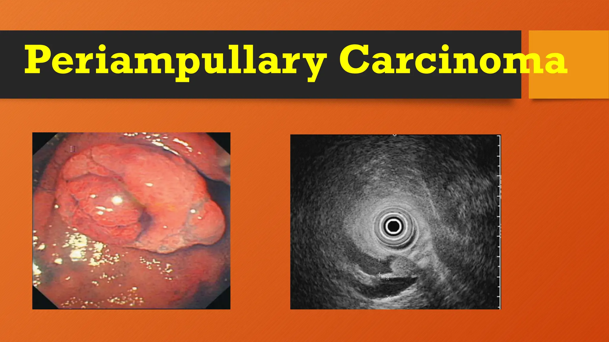 Periampullary Carcinoma
 