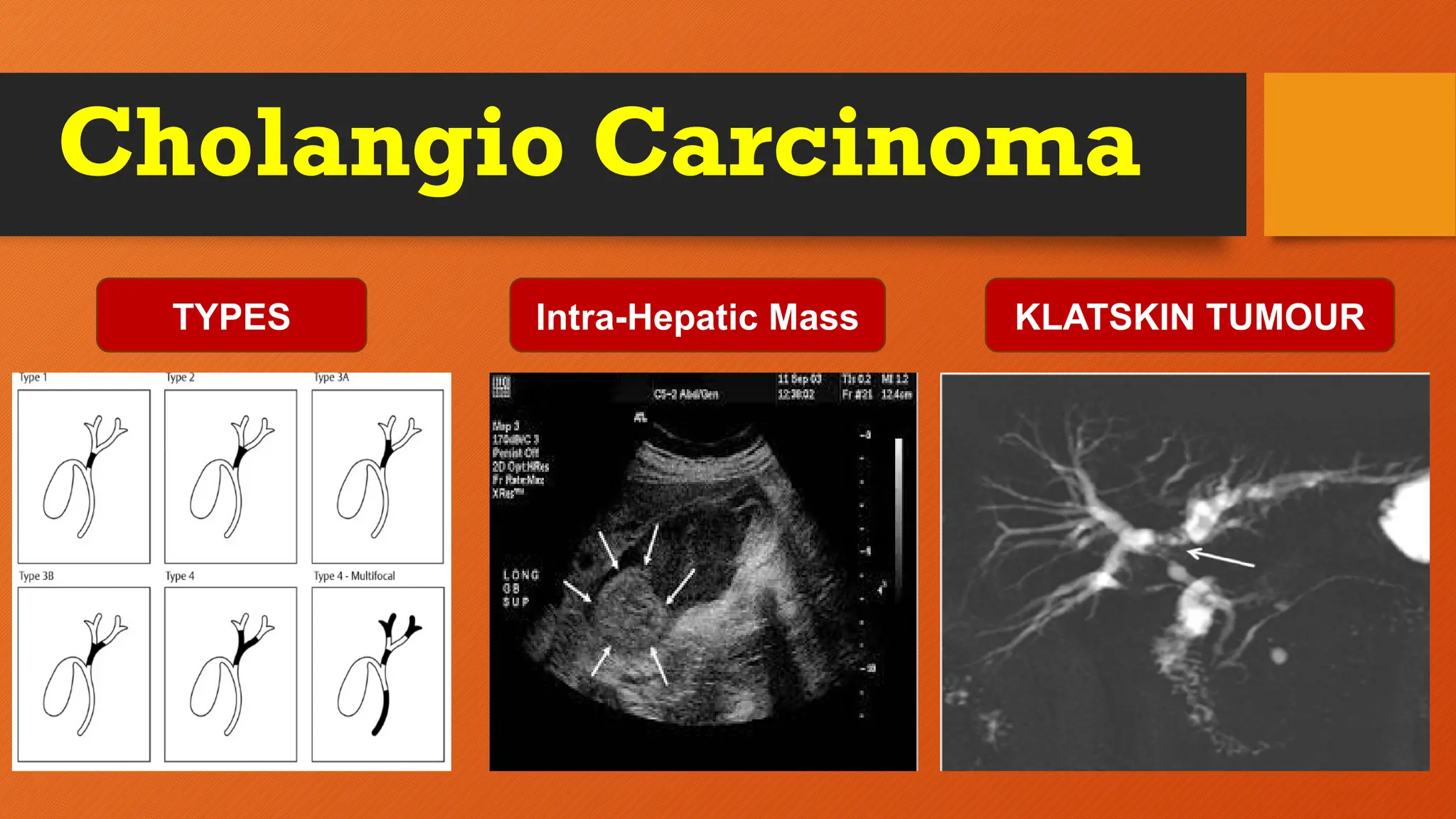 Cholangio Carcinoma
TYPES Intra-Hepatic Mass KLATSKIN TUMOUR
 