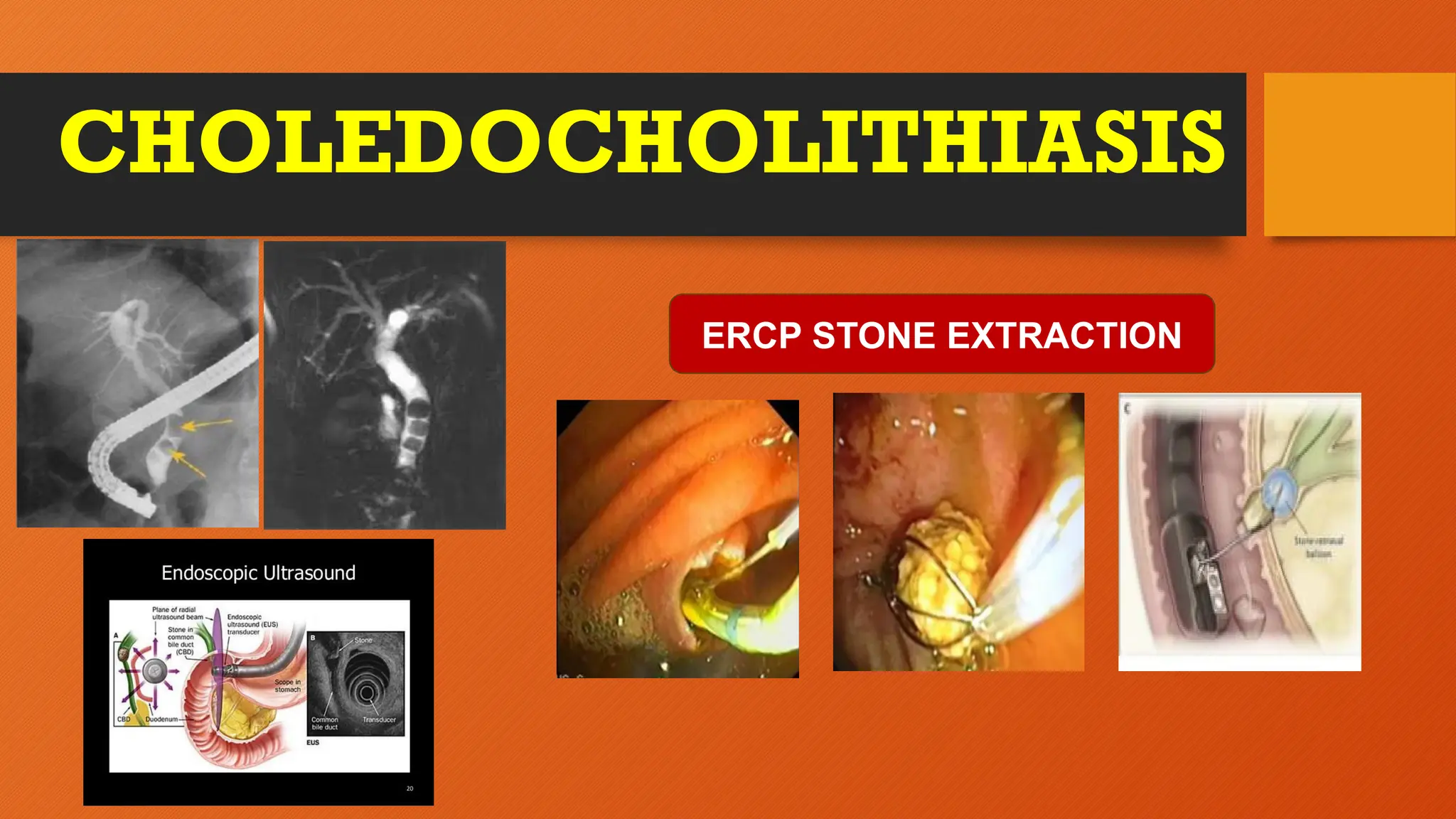 CHOLEDOCHOLITHIASIS
ERCP STONE EXTRACTION
 