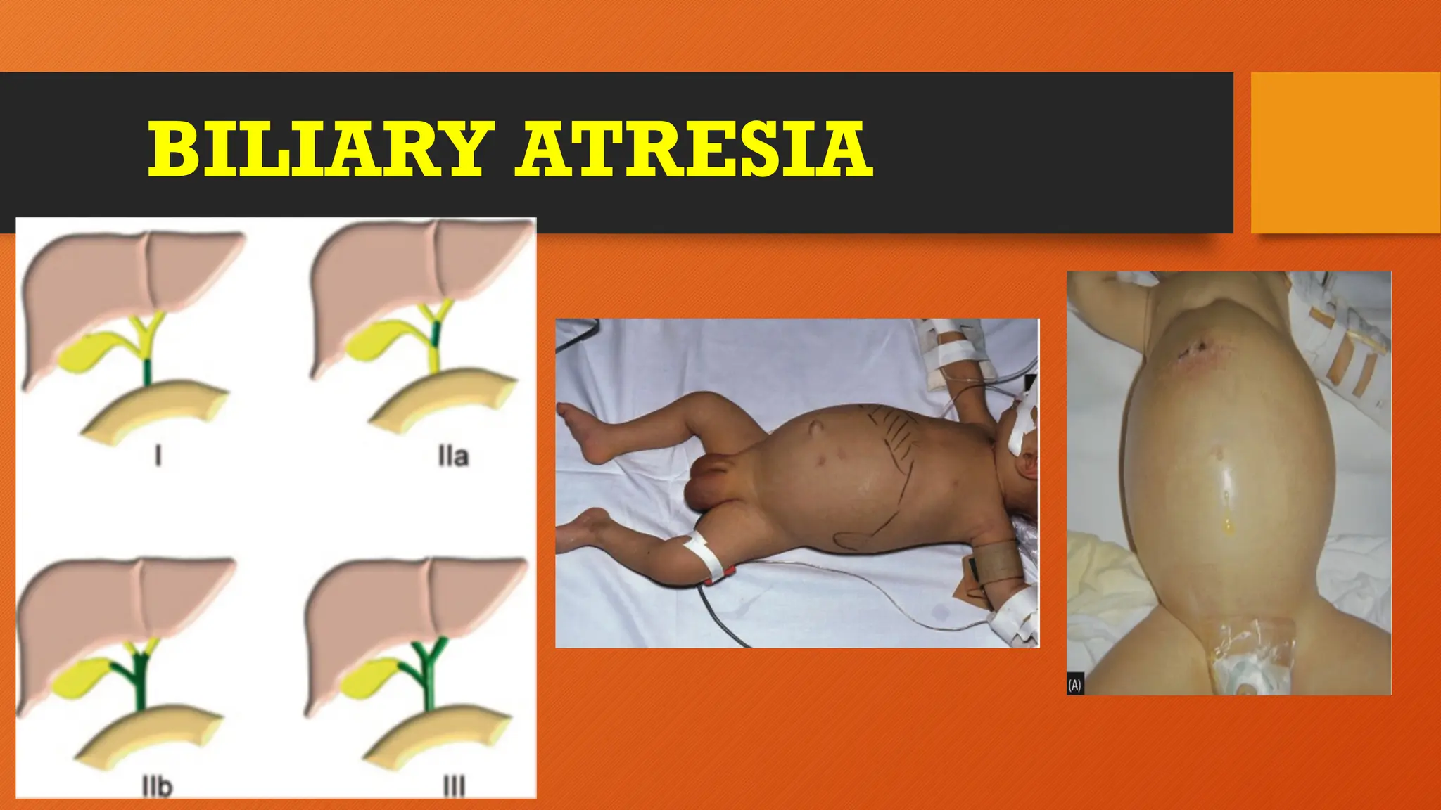 BILIARY ATRESIA
 