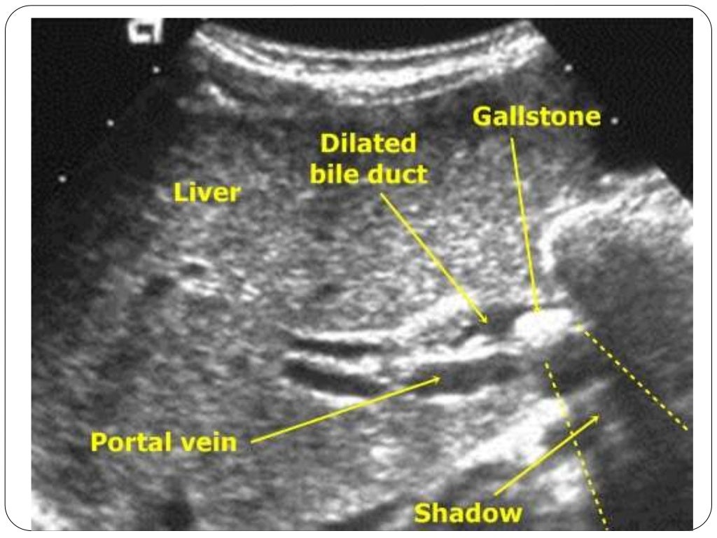 Obstructive jaundice 1
