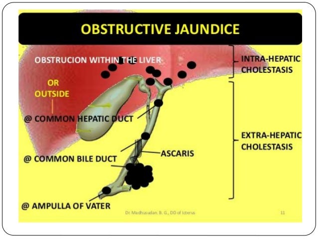 clinical presentation of obstructive jaundice