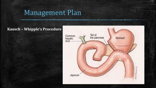 Management Plan
Kausch – Whipple’s Procedure
 