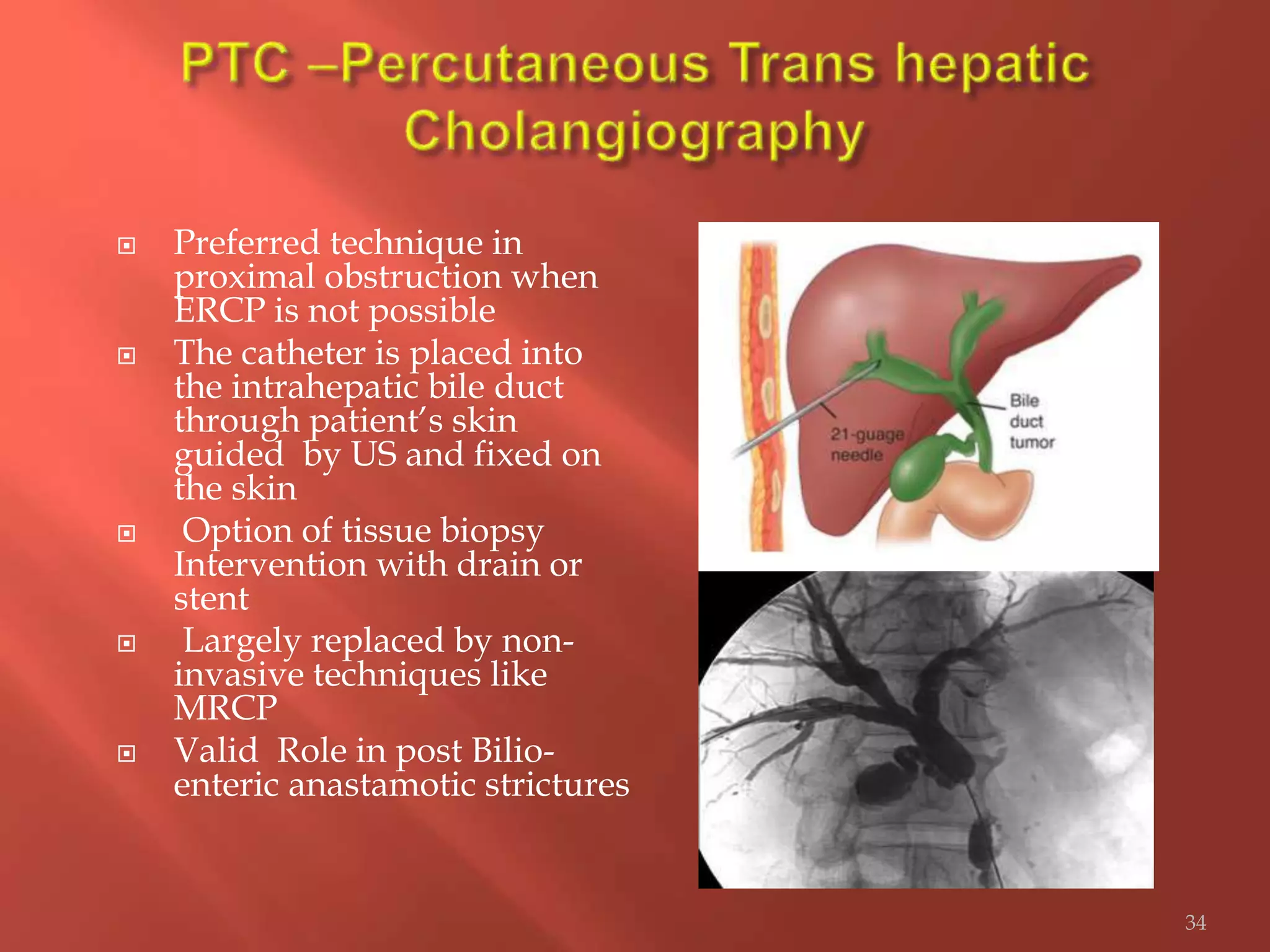 Preferred technique in
proximal obstruction when
ERCP is not possible
 The catheter is placed into
the intrahepatic bile duct
through patient’s skin
guided by US and fixed on
the skin
 Option of tissue biopsy
Intervention with drain or
stent
 Largely replaced by non-
invasive techniques like
MRCP
 Valid Role in post Bilio-
enteric anastamotic strictures
34
 