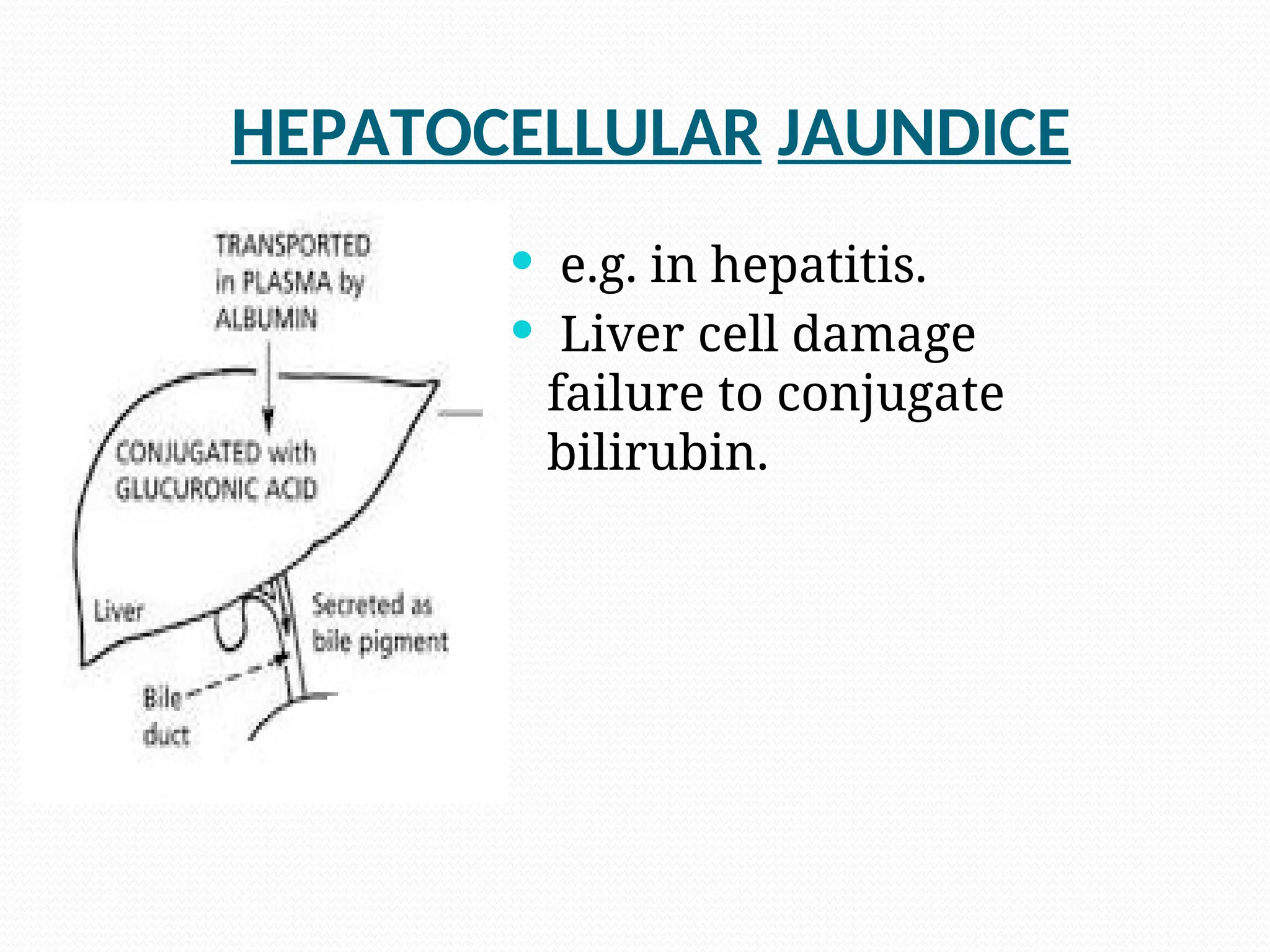 HEPATOCELLULAR JAUNDICE
.
 e.g. in hepatitis.
 Liver cell damage
failure to conjugate
bilirubin.
 