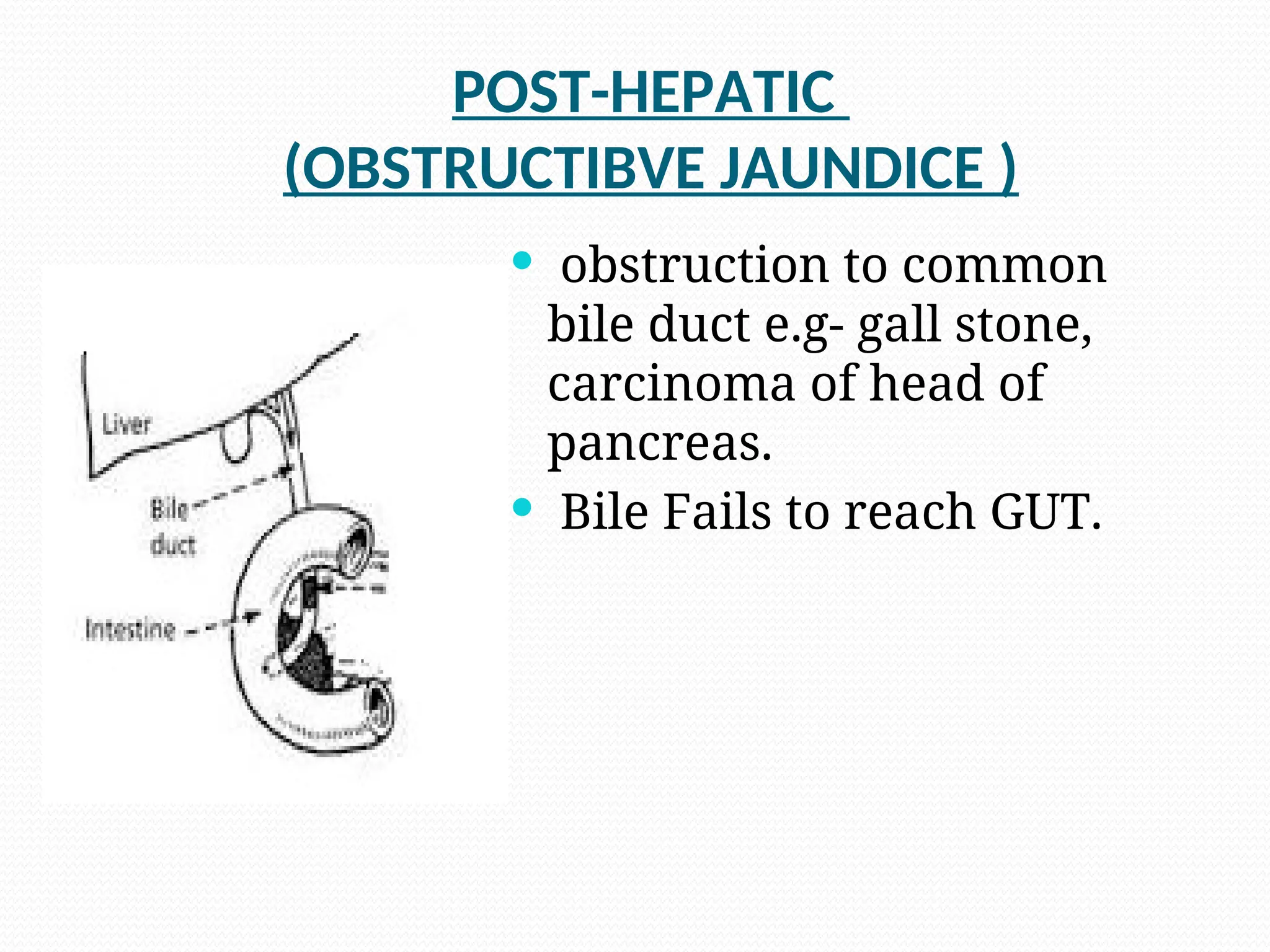 POST-HEPATIC
(OBSTRUCTIBVE JAUNDICE )
.  obstruction to common
bile duct e.g- gall stone,
carcinoma of head of
pancreas.
 Bile Fails to reach GUT.
 
