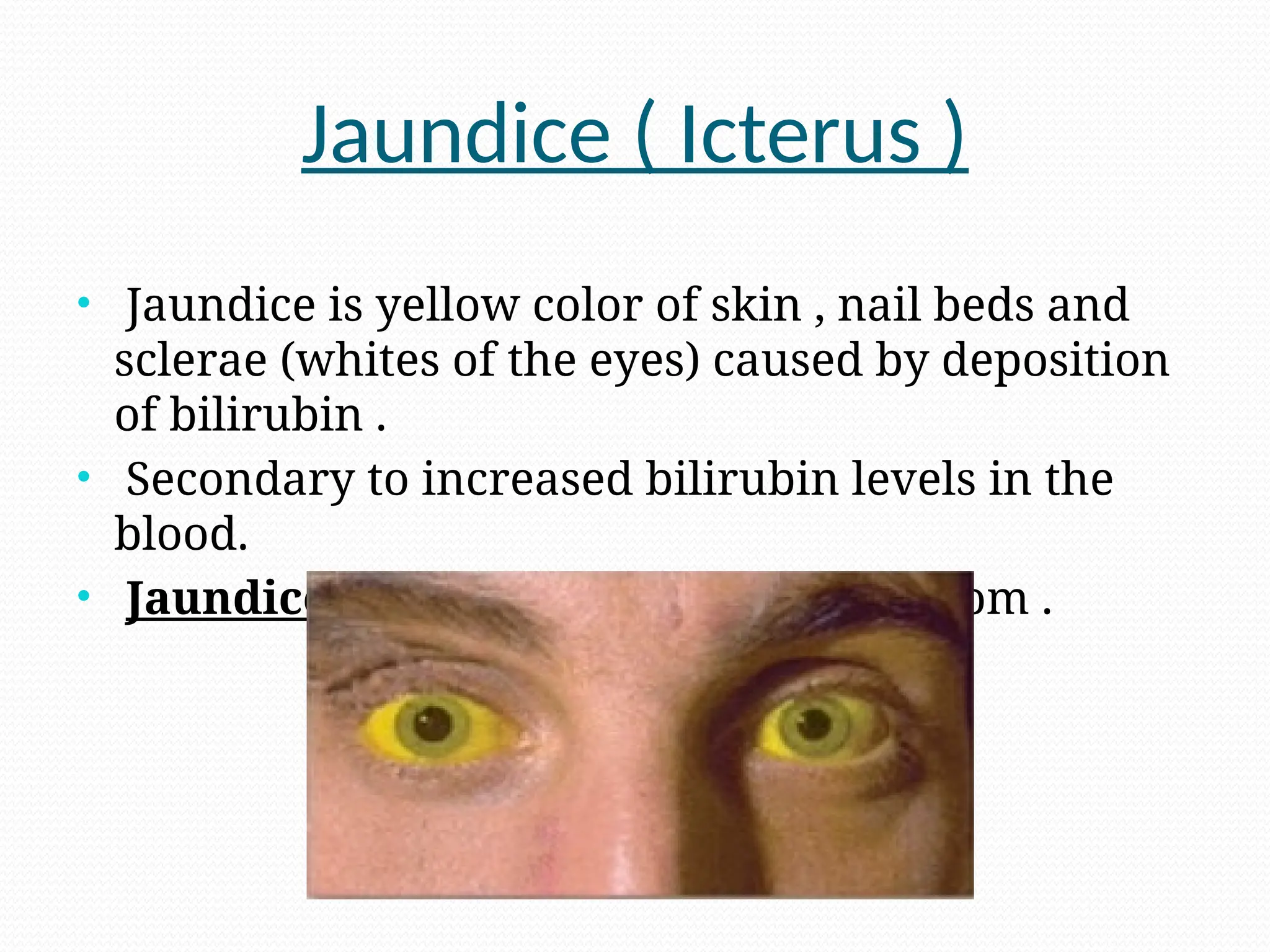 Jaundice ( Icterus )
• Jaundice is yellow color of skin , nail beds and
sclerae (whites of the eyes) caused by deposition
of bilirubin .
• Secondary to increased bilirubin levels in the
blood.
• Jaundice is not a disease but a symptom .
 