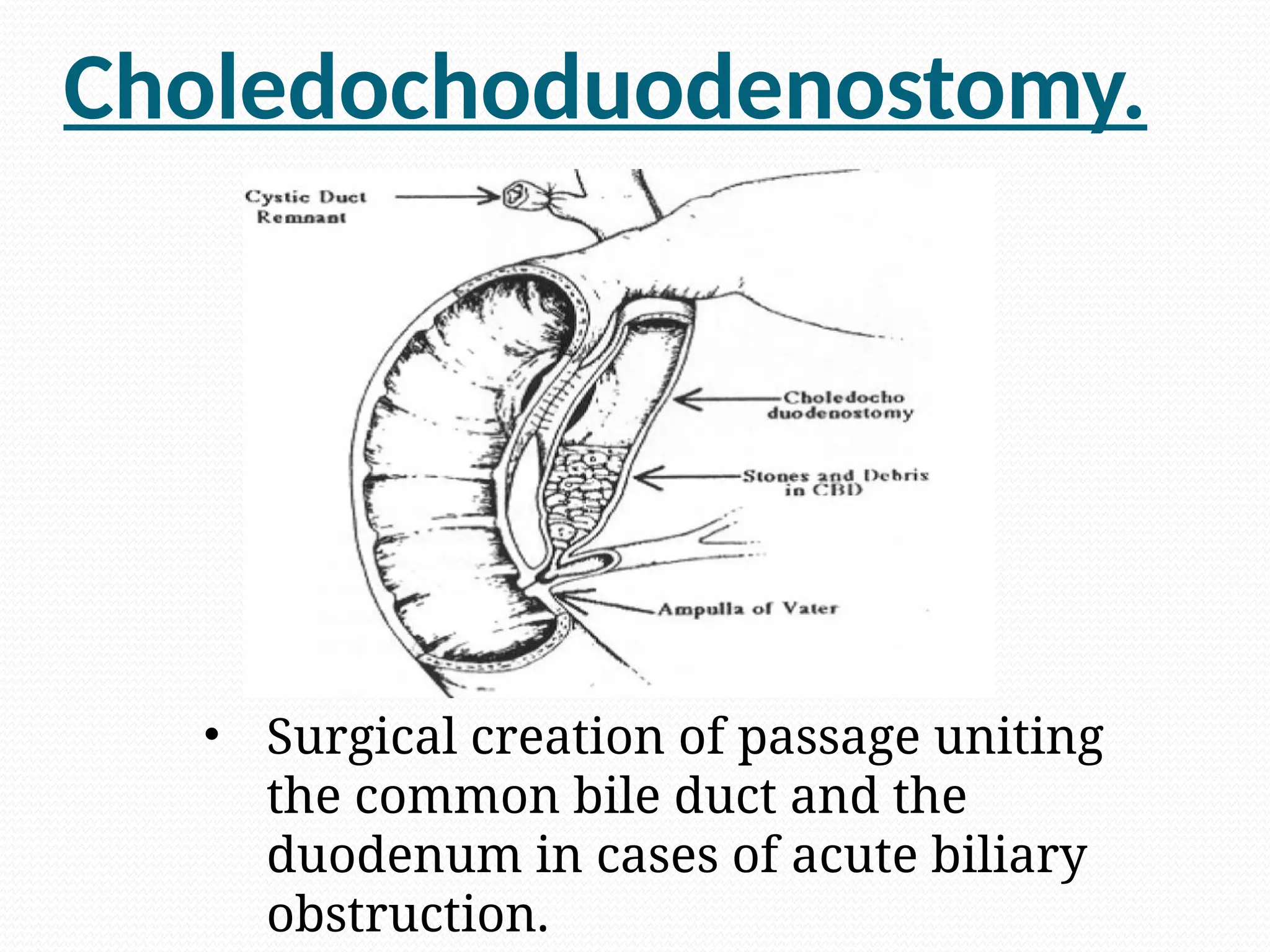 Choledochoduodenostomy.
• Surgical creation of passage uniting
the common bile duct and the
duodenum in cases of acute biliary
obstruction.
 