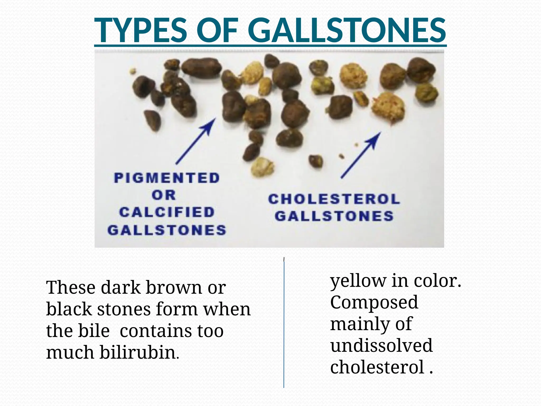 TYPES OF GALLSTONES
These dark brown or
black stones form when
the bile contains too
much bilirubin.
yellow in color.
Composed
mainly of
undissolved
cholesterol .
 